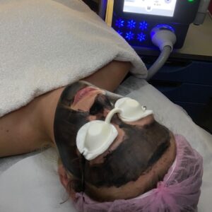 Laserowy Peeling Węglowy